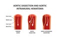 Aortic dissection and aortic intramural hematoma Royalty Free Stock Photo