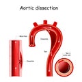 Aortic dissection. longitudinal and cross-section of blood vessel.