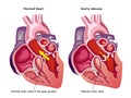 Aortic stenosis Royalty Free Stock Photo