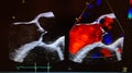 Aortic valve doppler echocardiogram with bloodflow shown in blue and red