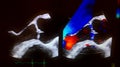 Aortic valve doppler echocardiogram with bloodflow shown in blue and red