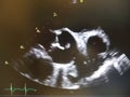 Aortic Valve Vegetation Shown on Live Echocardiogram