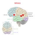 Aphasia. Human Brain with damage to specific areas