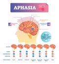 Aphasia vector illustration. Labeled educational scheme with brain disorder