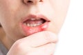 Aphtha on woman lower lip Royalty Free Stock Photo