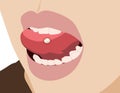 Aphthae or aphtha tongue close up, unhealthy in oral, illustration cartoon