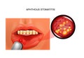 Aphthous stomatitis. aphthae Royalty Free Stock Photo