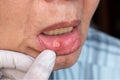 Aphthous ulcer, canker sore or stress ulcer in the mouth Royalty Free Stock Photo