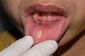 Aphthous ulcer or stress ulcer in mouth of Asian patient Royalty Free Stock Photo