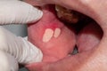 Aphthous ulcer or stress ulcer in mouth of Asian patient