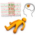 Apoplectic And Epileptic Stroke