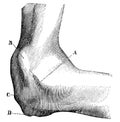 Appearance of the dislocated elbow joint.