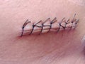 The appearance of suture sutures in the skin that is widely open