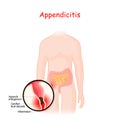 Appendicitis. closeup of appendix with Inflammation