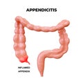 Appendicitis consists of inflammation and infection of the appendix, a small segment that emerges from the large intestine