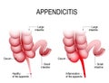 Appendicitis