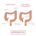 Appendicitis illustration