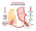 Appendicitis, inflamed appendix, abdominal problem diagnosis outline diagram