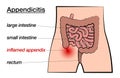 Appendicitis Inflamed Appendix Labeled Chart Royalty Free Stock Photo