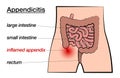 Appendicitis Inflamed Appendix Labeled Chart