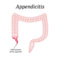 Appendicitis. Inflammation of the appendix. Colon. The illustration on background