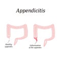 Appendicitis. Inflammation of the appendix. Colon