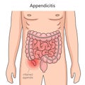 Appendicitis inflammation of appendix medical