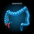 Appendicitis. large intestine on dark background