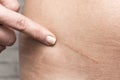 Appendicitis scar on woman`s stomach