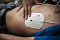 Application of defibrillation electrodes