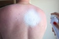 Apply sunburn cream on a man`s burned back. Royalty Free Stock Photo