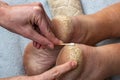 Applying cream to cracked heels. Close-up of a woman& x27;s hand applying a moisturizing nourishing cream to the heels of Royalty Free Stock Photo