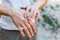 Applying an emollient to dry flaky skin as in the treatment of psoriasis, eczema and other dry skin conditions. White Royalty Free Stock Photo