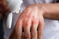 Applying an emollient to dry flaky skin as in the treatment of psoriasis, eczema and other dry skin conditions