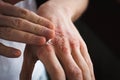 Applying an emollient to dry flaky skin as in the treatment of psoriasis, eczema and other dry skin conditions Royalty Free Stock Photo