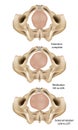 ardinal movements of Childbirth. Foetus rotation onset of labour Extension complete, Restitution OA to LOA