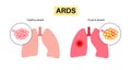 ARDS anatomical poster