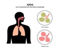 ARDS anatomical poster