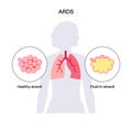 ARDS anatomical poster