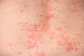 An area of the body covered with an allergic rash, very close-up