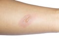 Arm with blister or burn skin Royalty Free Stock Photo