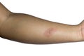 Arm with blister or burn skin