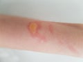 Arm with burn blister Royalty Free Stock Photo