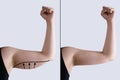 Before And After Arm Cellulite Surgery And Liposuction Royalty Free Stock Photo