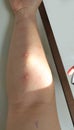 Arm examine with allergy skin prick test rash reaction aero dust mite sensitive