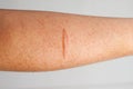 Arm Scar Royalty Free Stock Photo