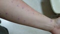 Arm showing food allergy skin prick test with rash sensitive reaction