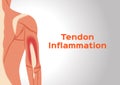 Arm tendon inflammation Royalty Free Stock Photo