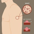 Arm warts, close-up with enlargement detail and cross-section wart treatment illustration