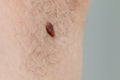 Precancerous mole on armpit - birthmark is potentially cancerous melanoma